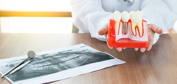 Dental Implant