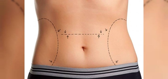 Abdominoplasty