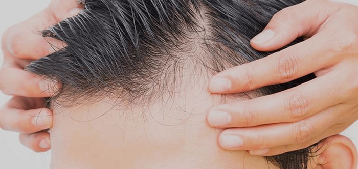TDF Hair Transplant